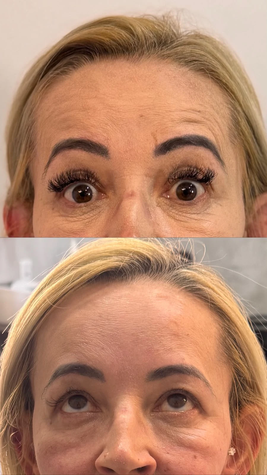 Antes e depois Botox 4: Depois