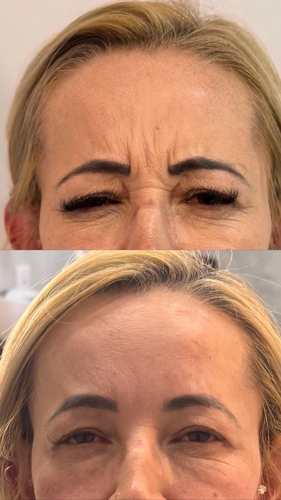 Antes e depois Botox 3: Depois