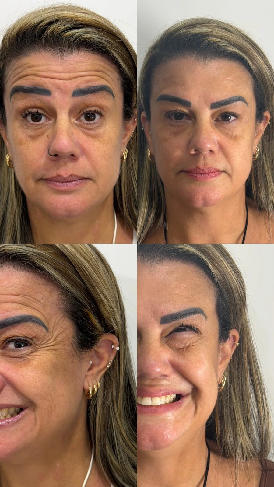 Antes e depois Botox 1: Depois